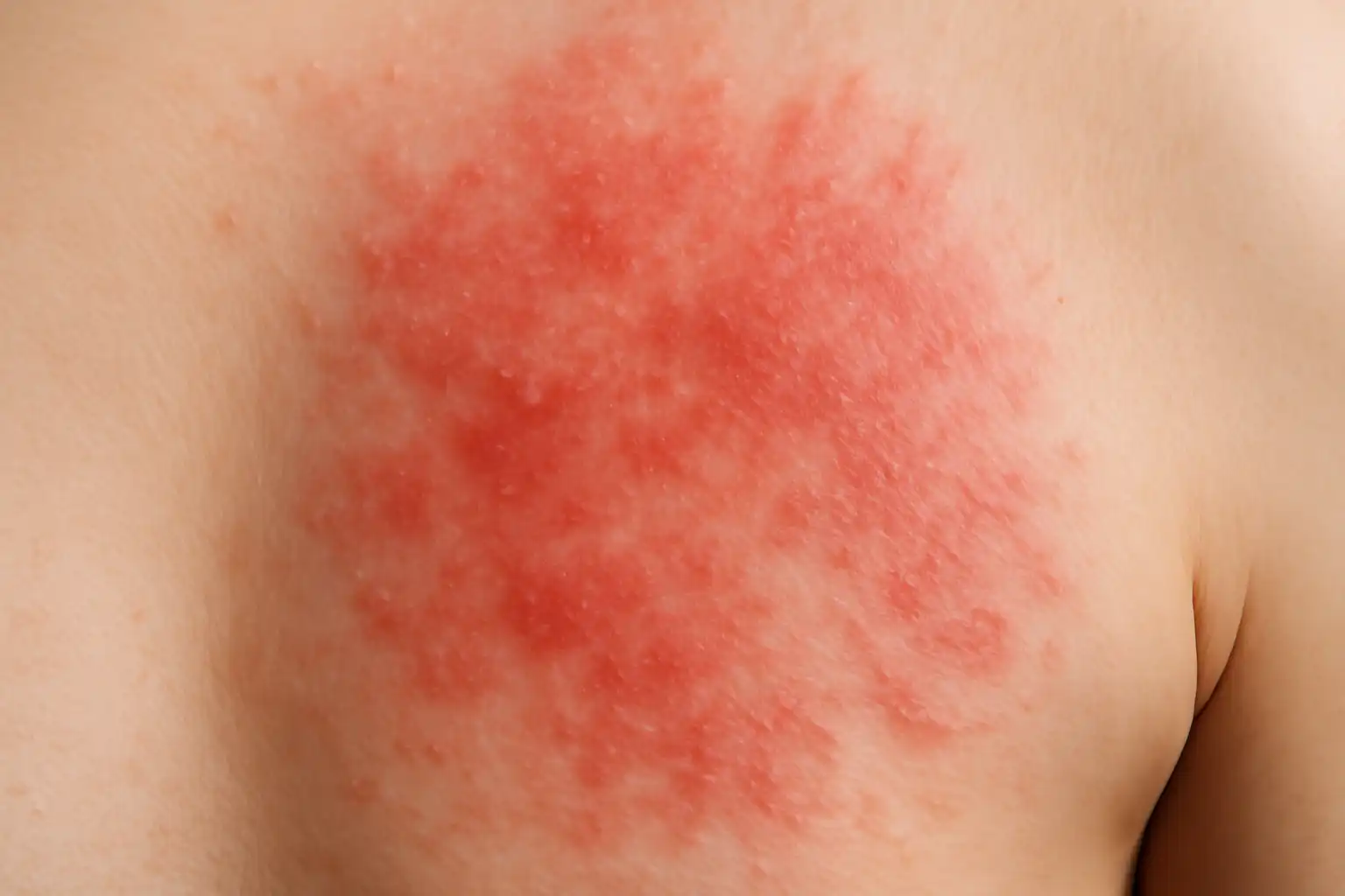 peau irritation rougeur